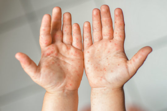 hand foot mouth disease
