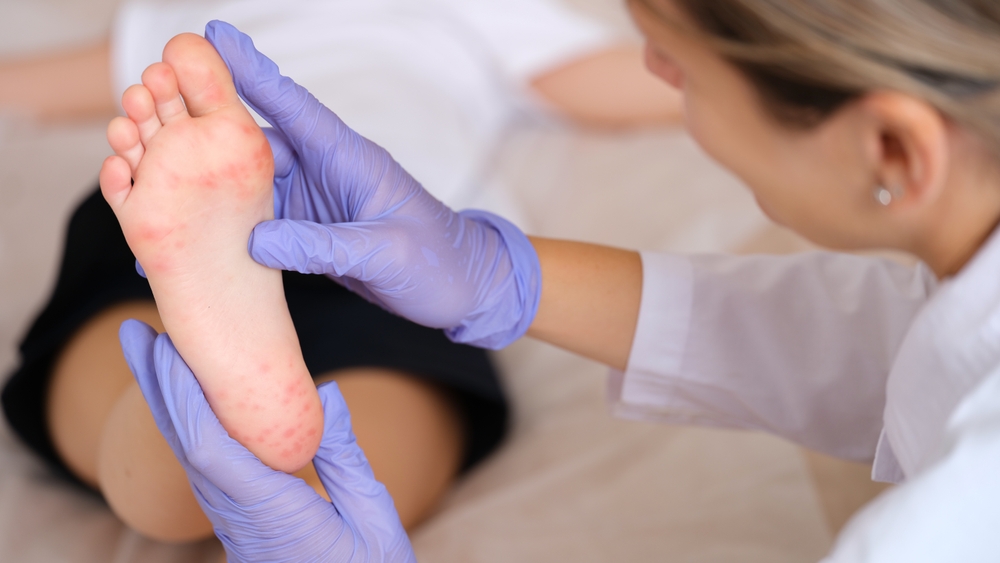 Hand foot mouth disease treament